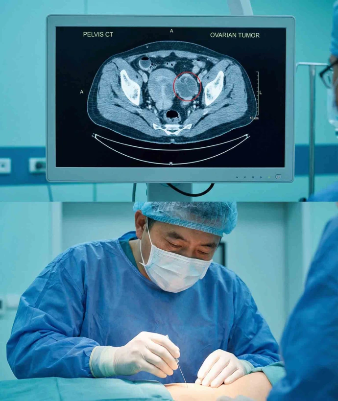 盆腔肿瘤微创/介入治疗
