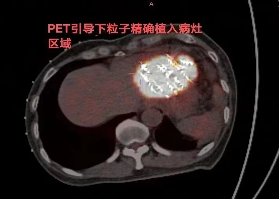 解放军第960医院肿瘤微创