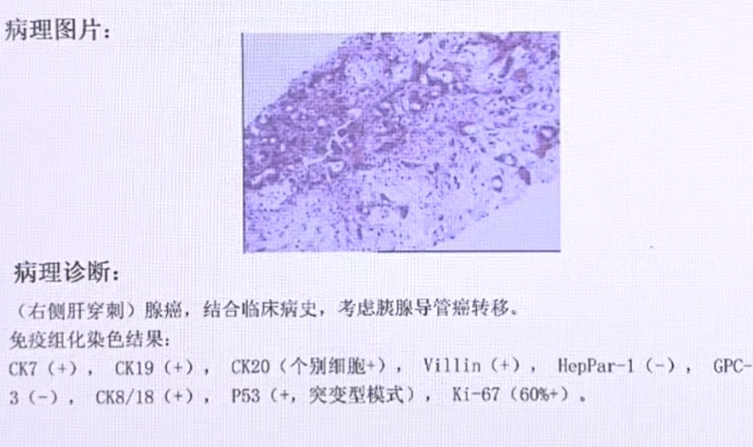 济南胰腺癌粒子