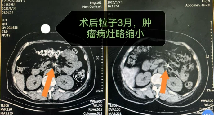 济南胰腺癌介入