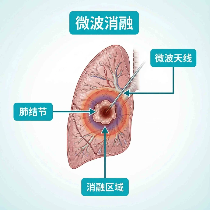 解放军第960医院肿瘤微创