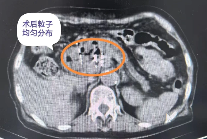 960医院 肿瘤介入