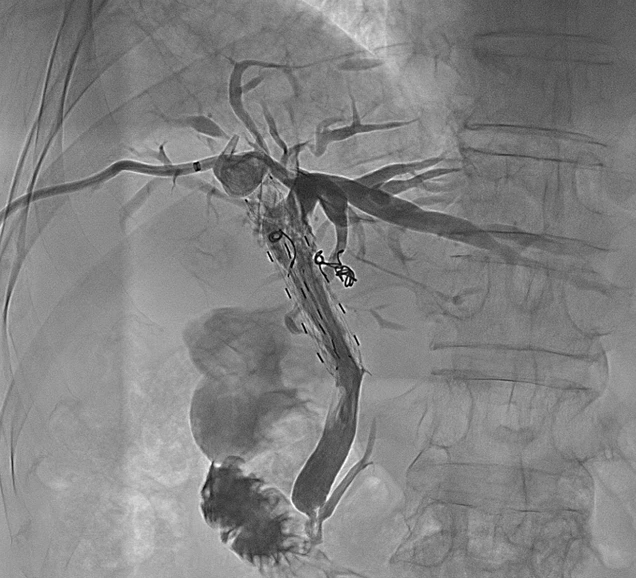 济南960医院胆管癌