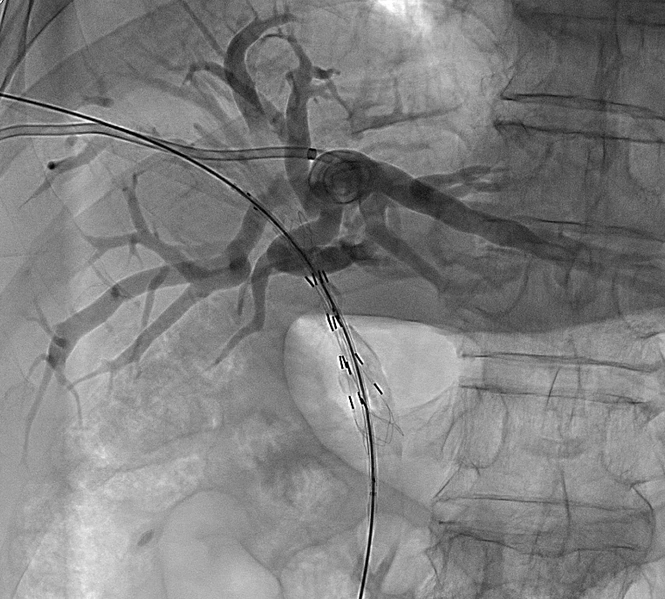 济南960医院胆管癌