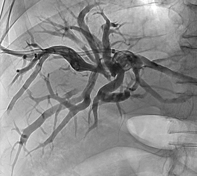 济南960医院胆管癌