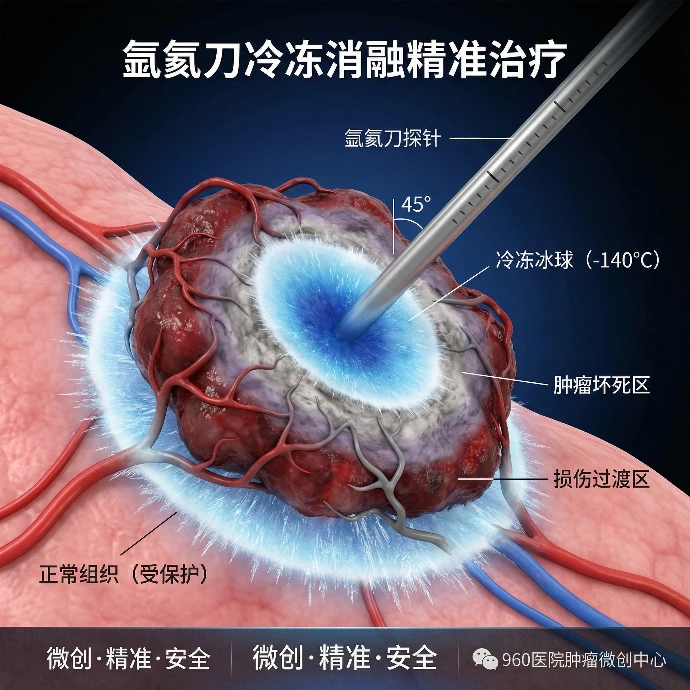 氩氦刀冷冻消融：精准“冻杀”肿瘤，激活全身免疫的抗癌新策略